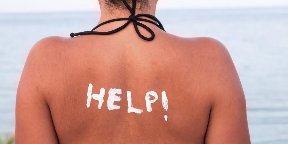 What to do for a sunburn when in Italy
