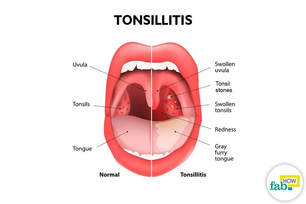 Tonsillitis