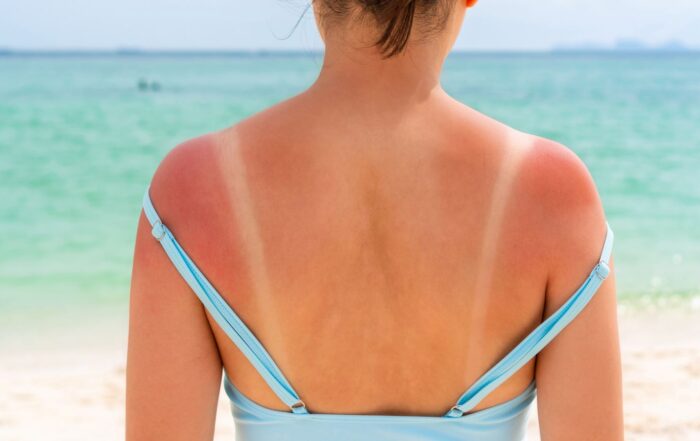 how to prevent sunburn